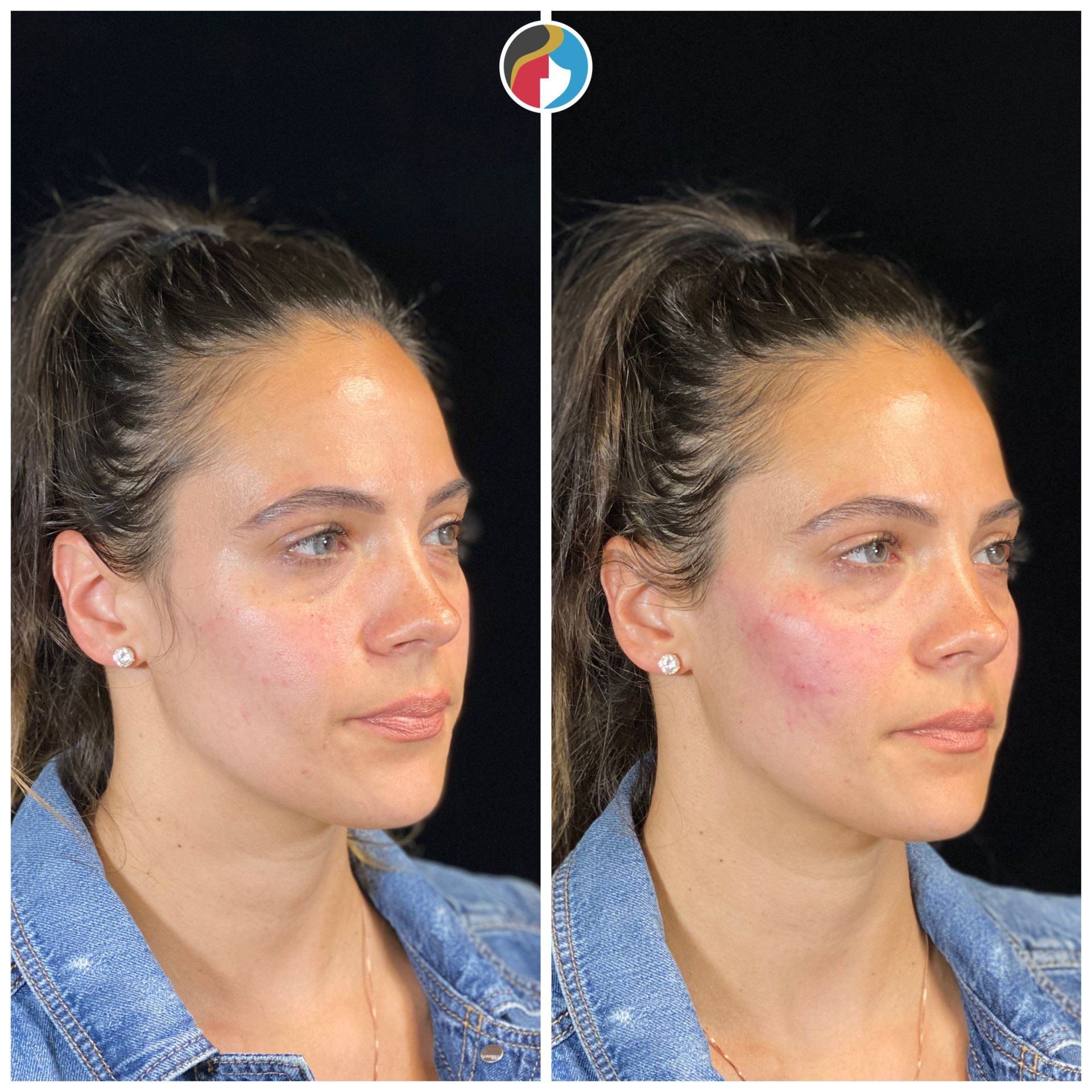 Dermal Filler Results