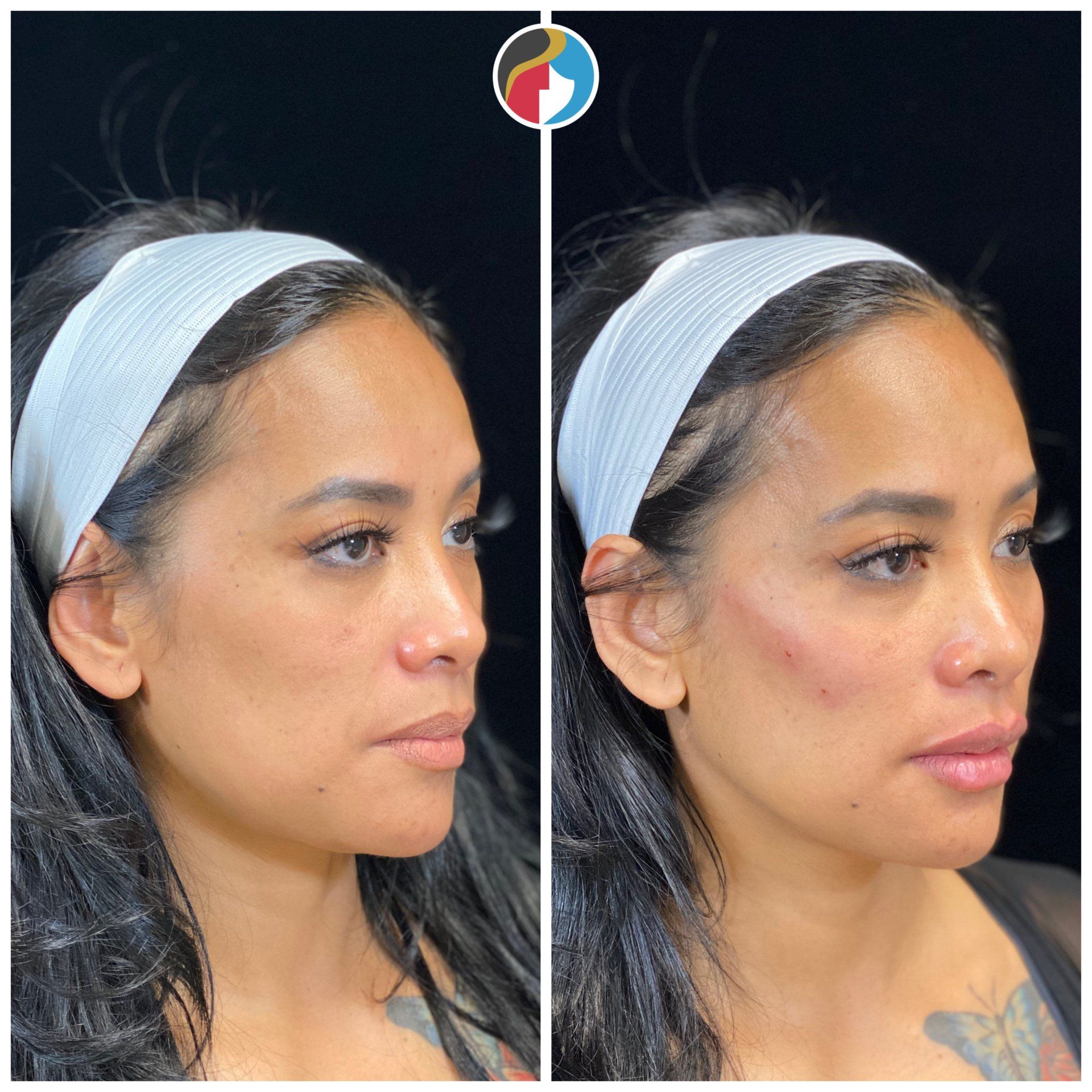 Dermal Filler Results