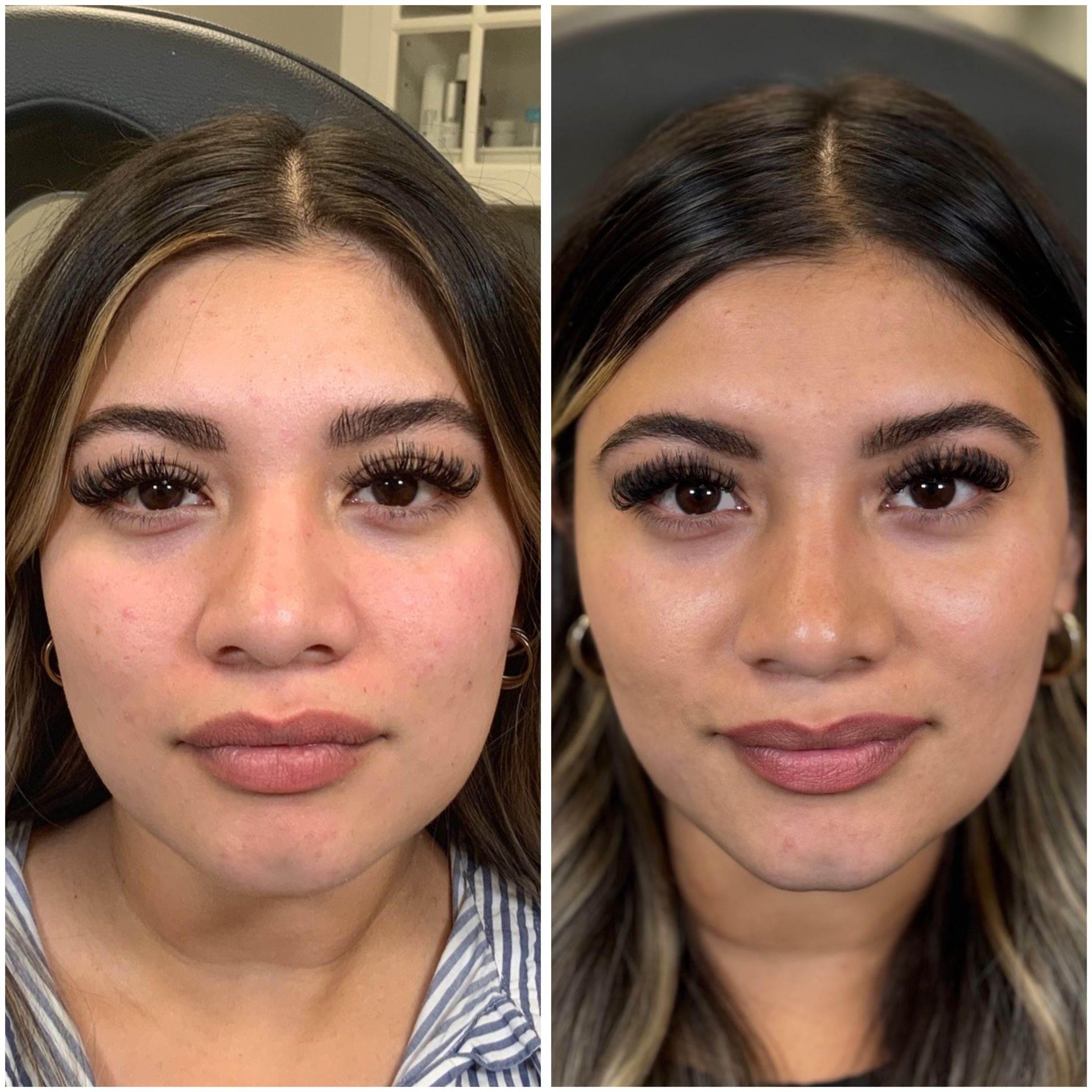 Botox Wrinkle Relaxer