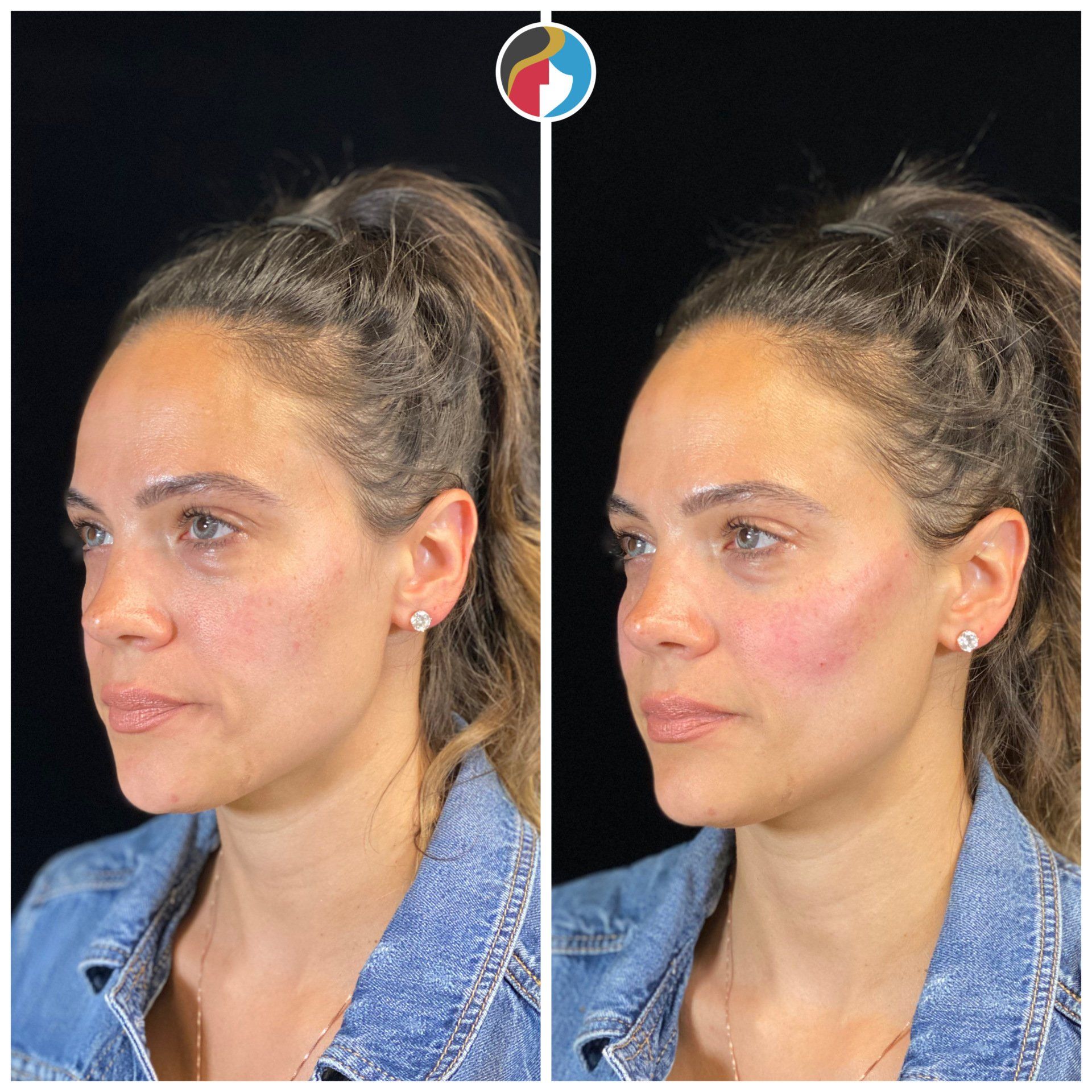 Dermal Filler Results