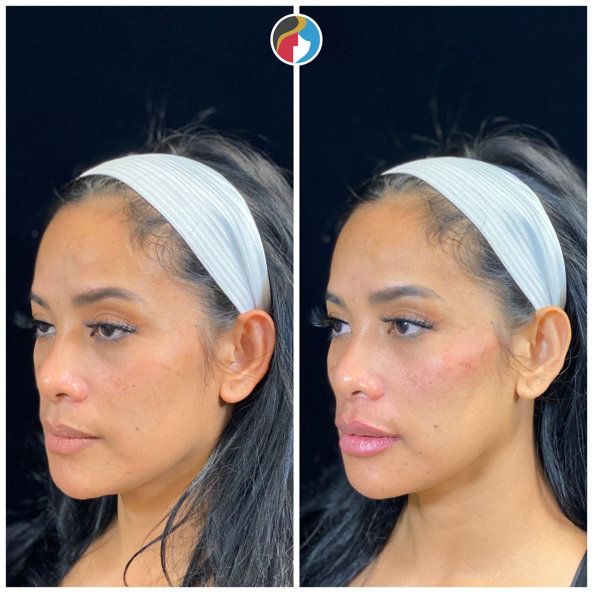 Dermal Filler Results