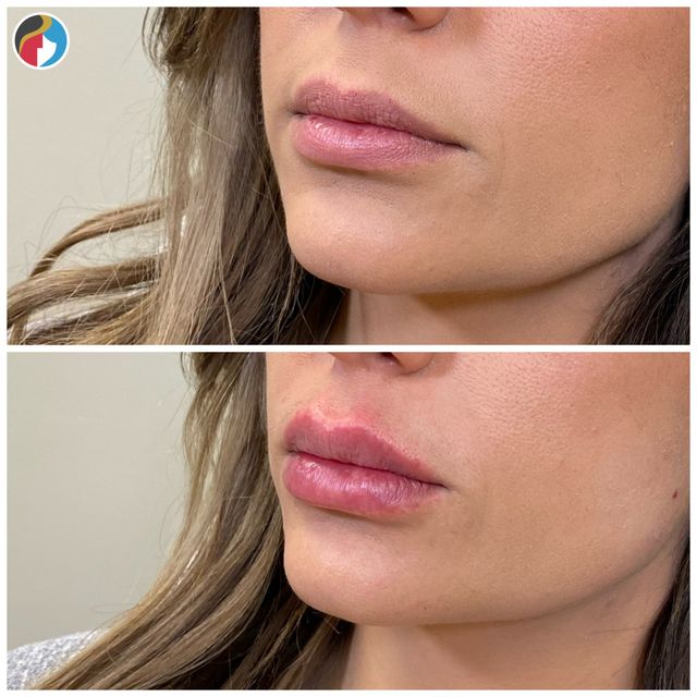 🫦 #lipflip #lipfiller #injectables #plasticsurgery #whatilearnedin202