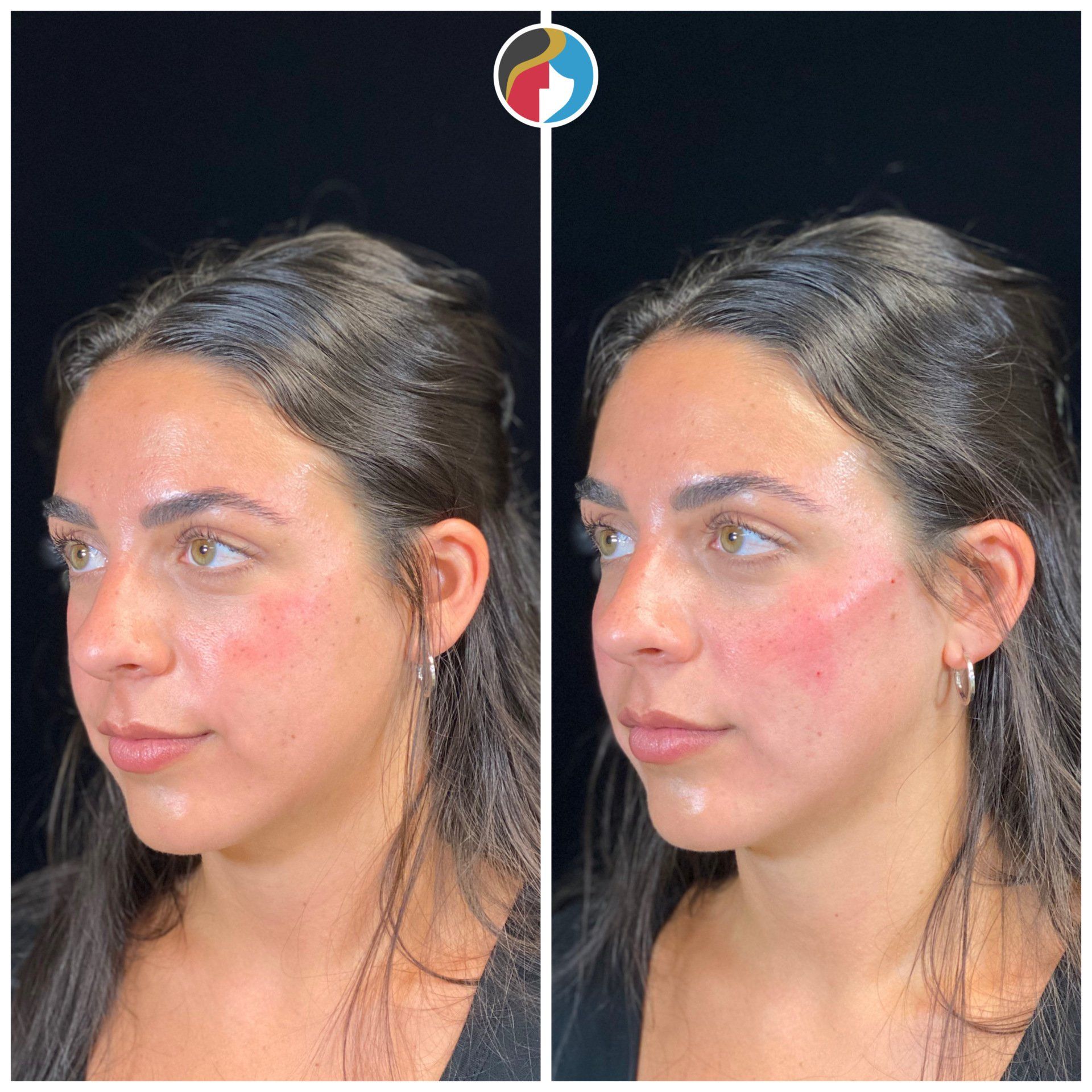 Dermal Filler Results