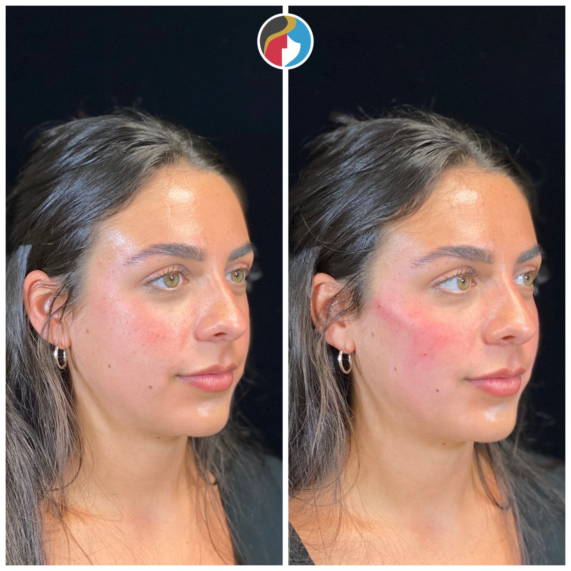 Dermal Filler Results