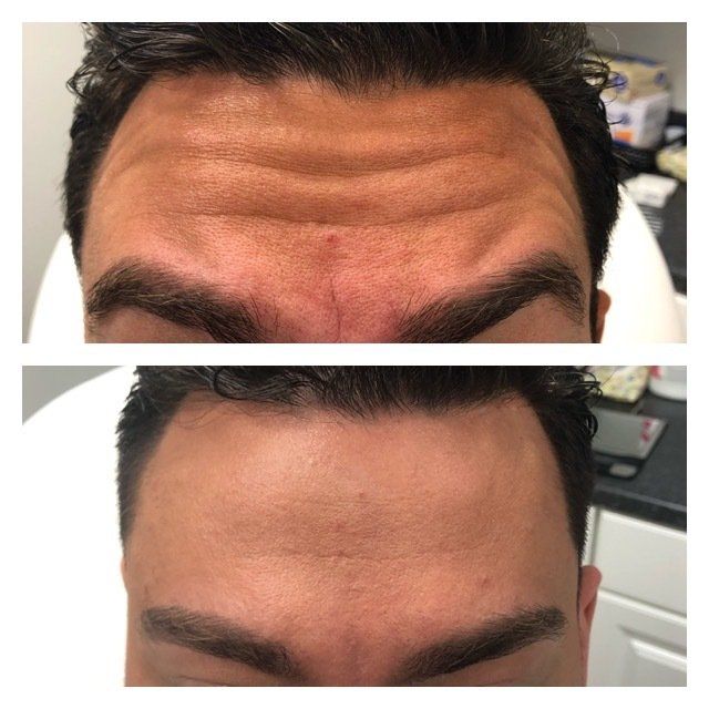 Botox treatment results in Syracuse 