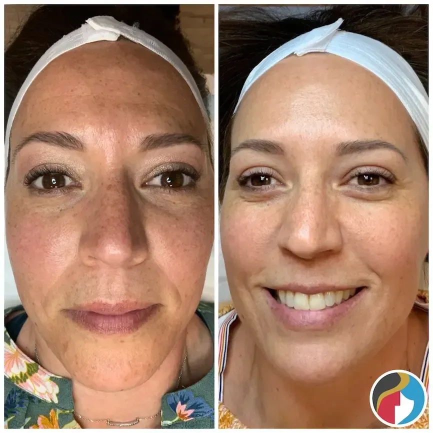 IPL Photofacial Treatment at Rejuvn8