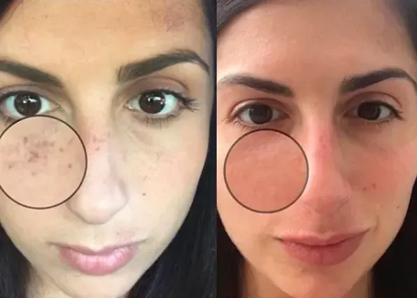 IPL Photofacial Treatment at Rejuvn8