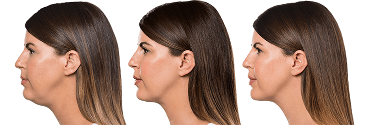 Kybella Treatment Results