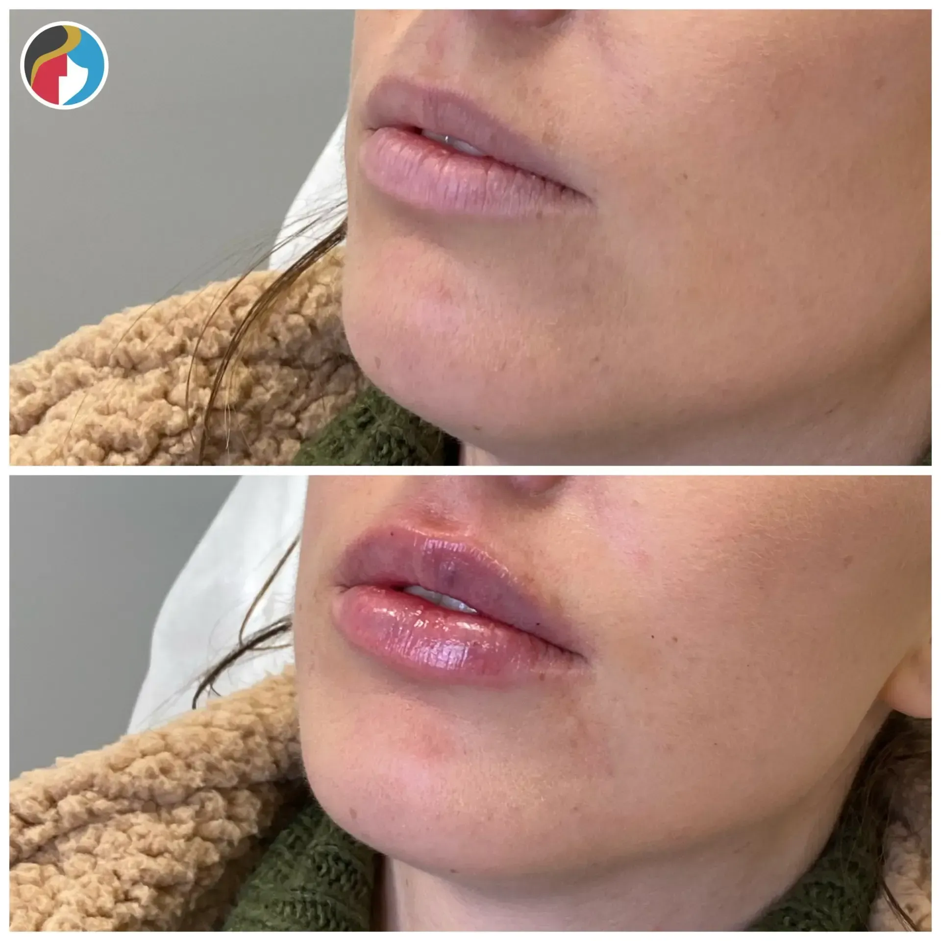 Lip Filler Results Lip Filler in Syracuse, New Hartford, and Albany, NY