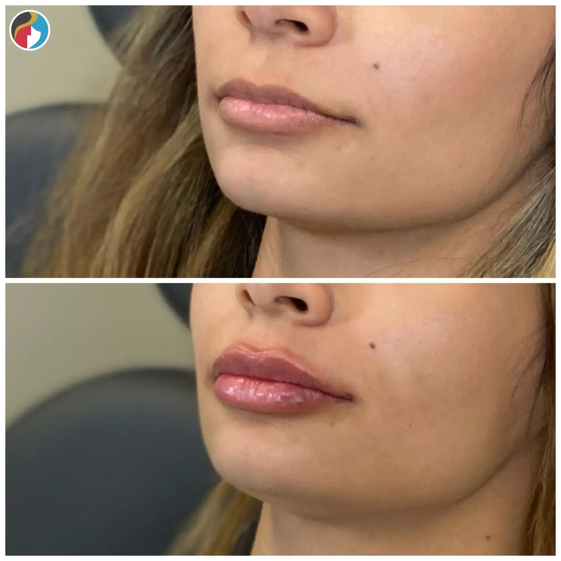 Lip Filler Results Lip Filler in Syracuse, New Hartford, and Albany, NY