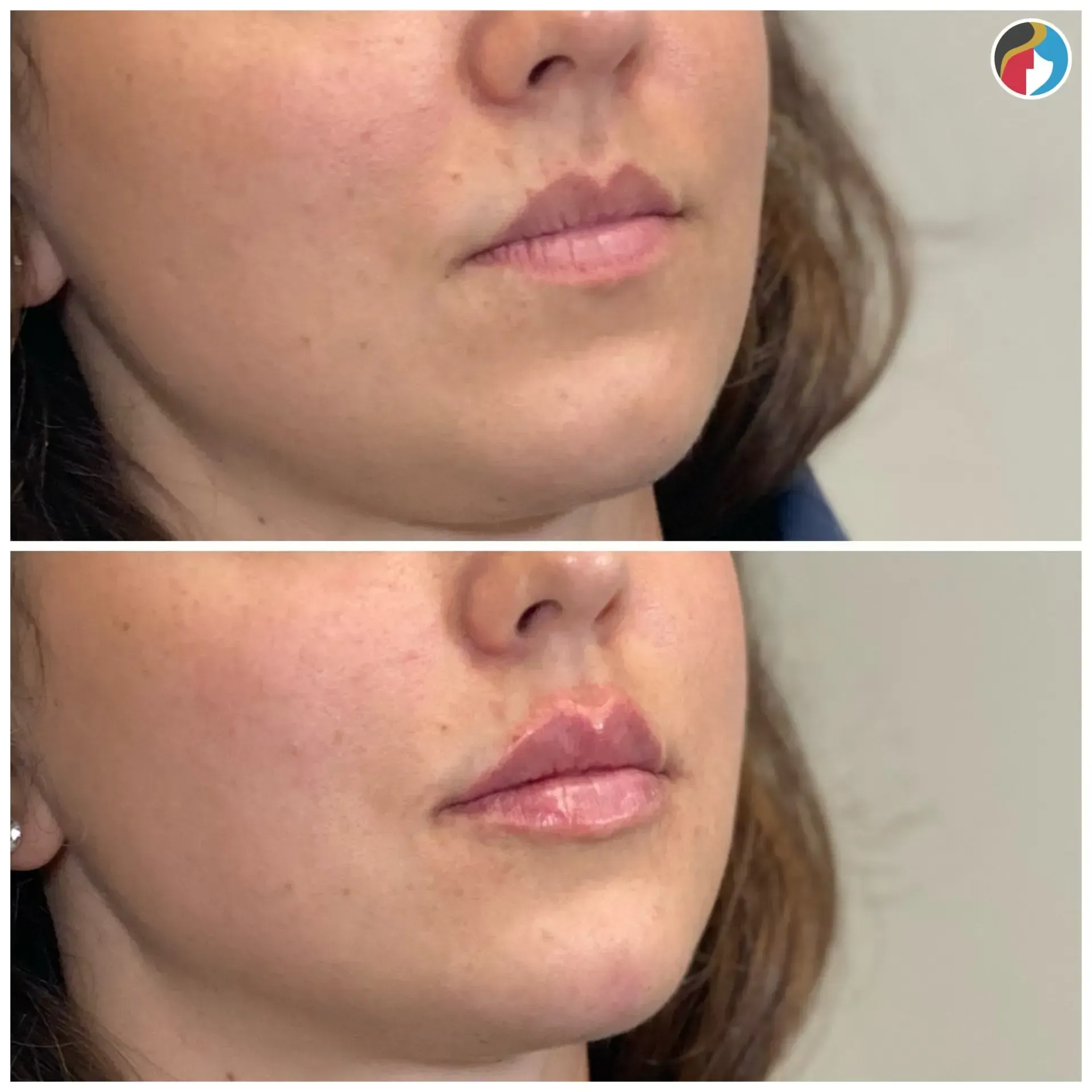 Lip Filler Results Lip Filler in Syracuse, New Hartford, and Albany, NY