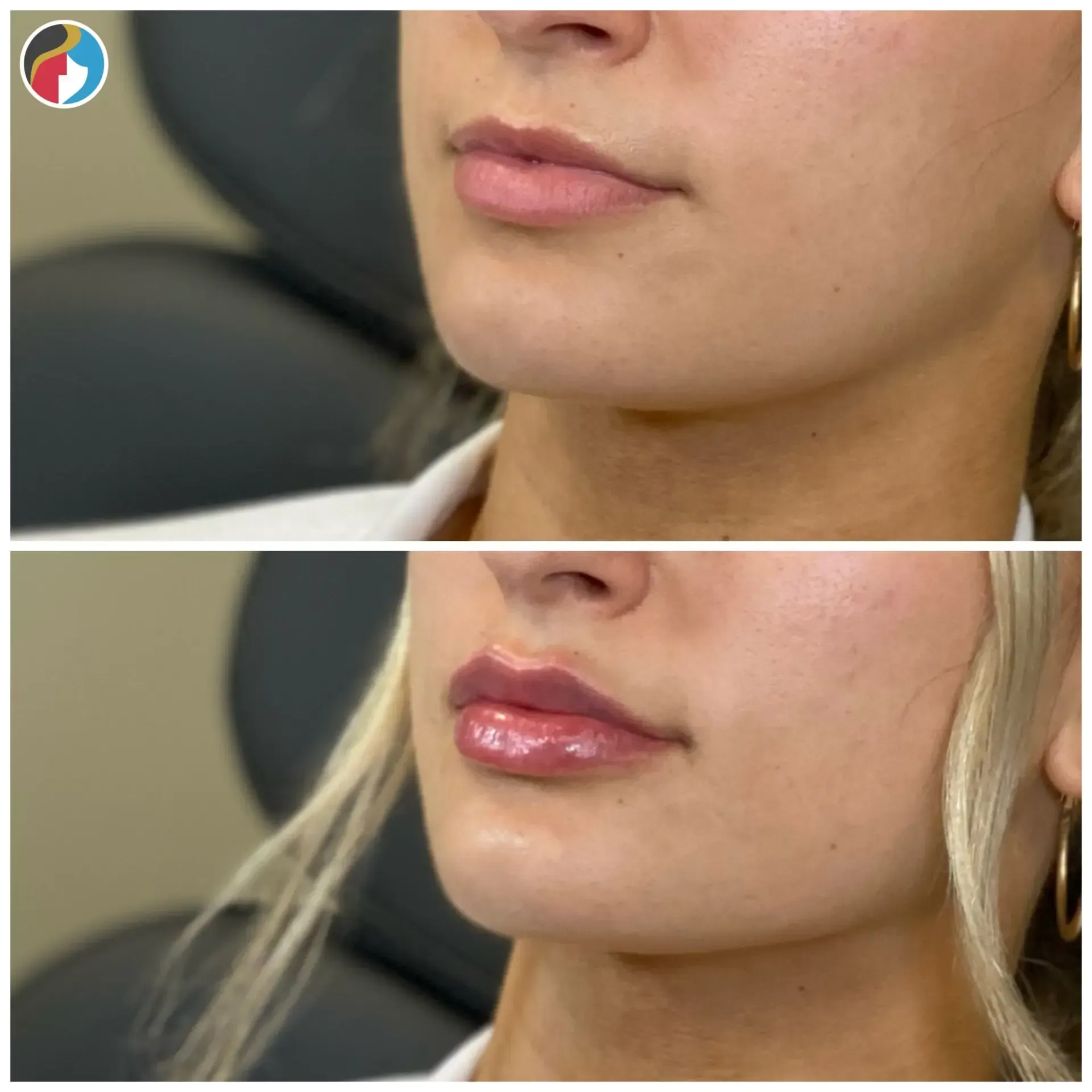 Lip Filler Results Lip Filler in Syracuse, New Hartford, and Albany, NY