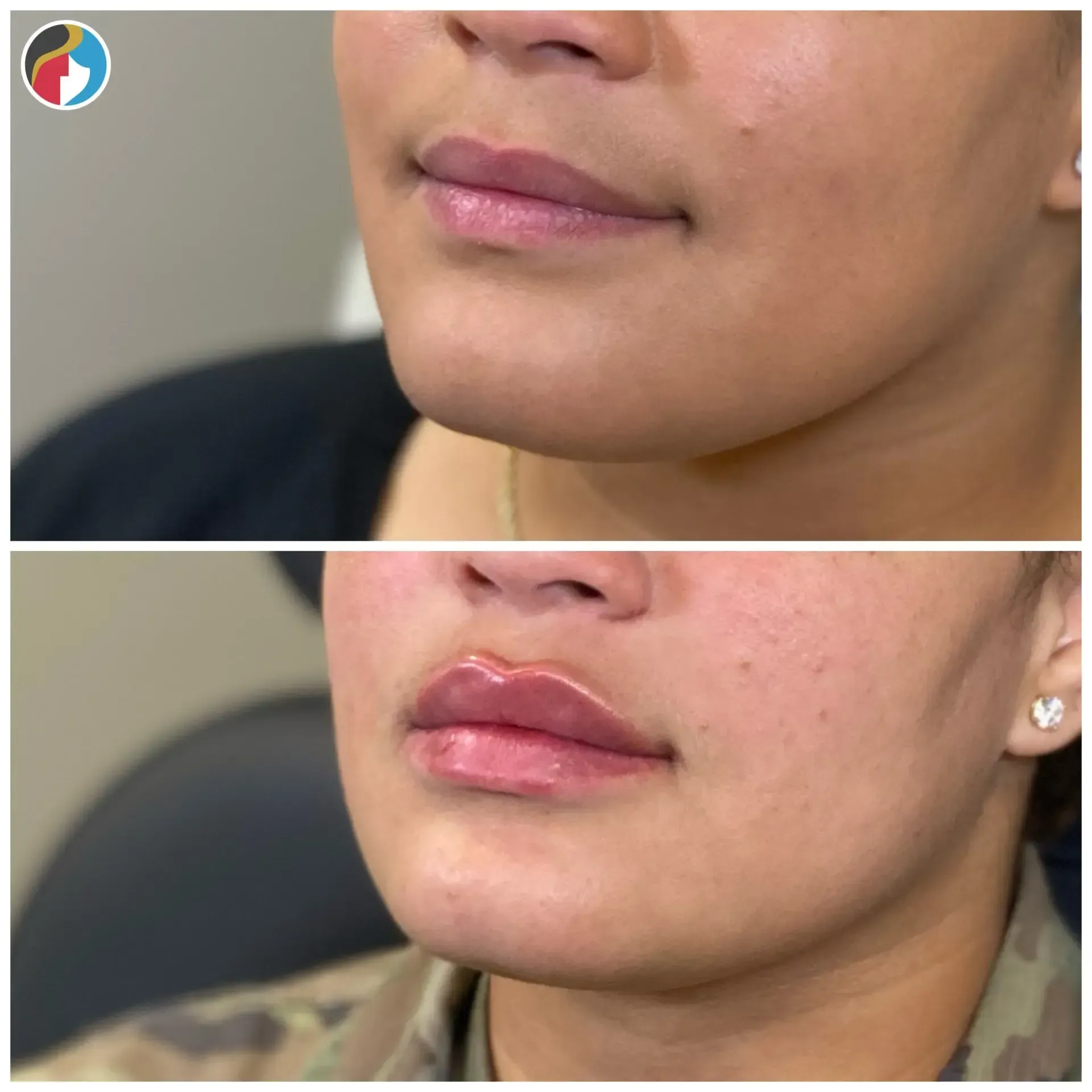 Lip Filler Results Lip Filler in Syracuse, New Hartford, and Albany, NY