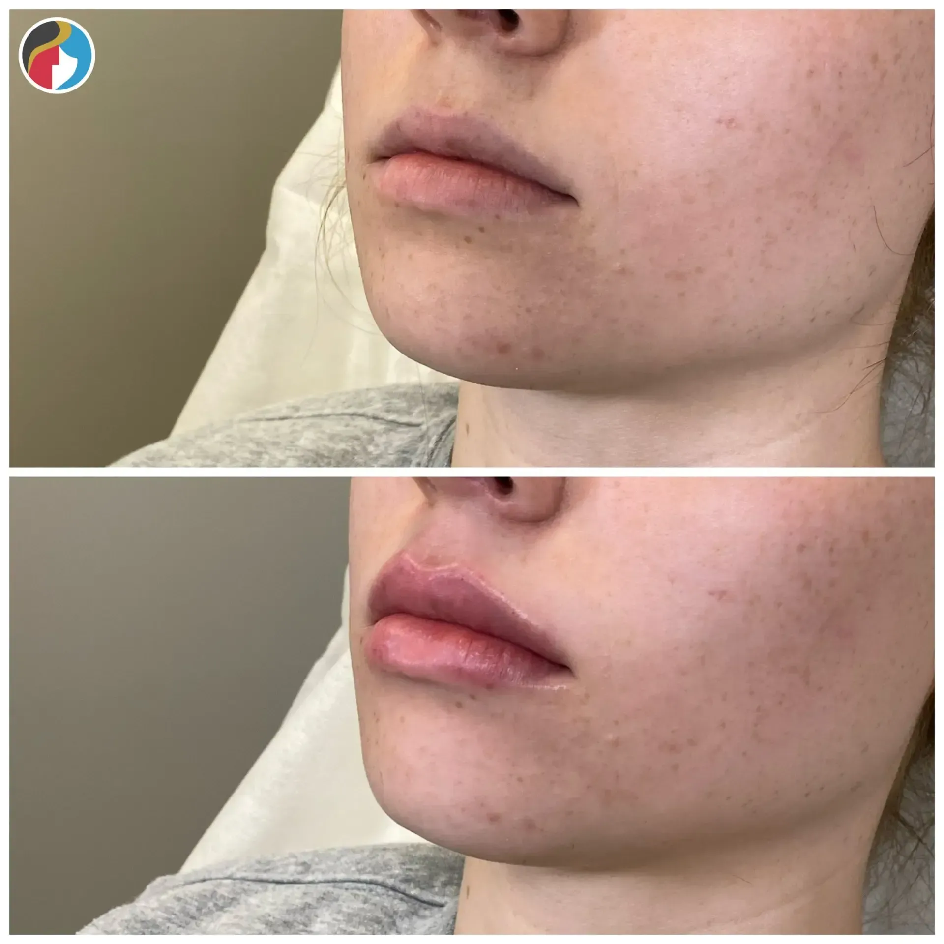 Lip Filler Results Lip Filler in Syracuse, New Hartford, and Albany, NY