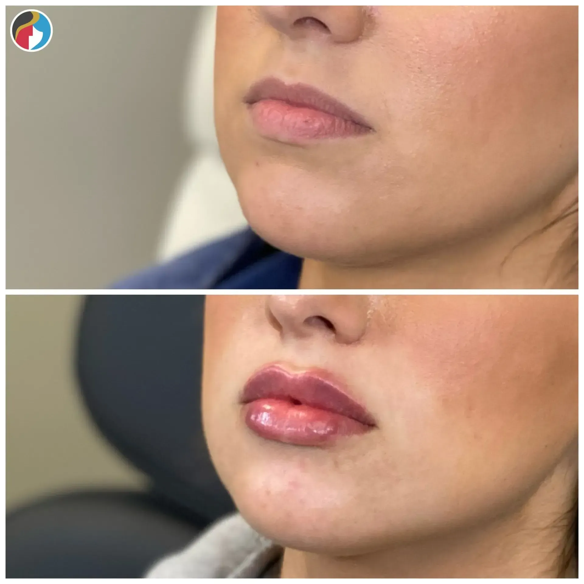Lip Filler Results Lip Filler in Syracuse, New Hartford, and Albany, NY