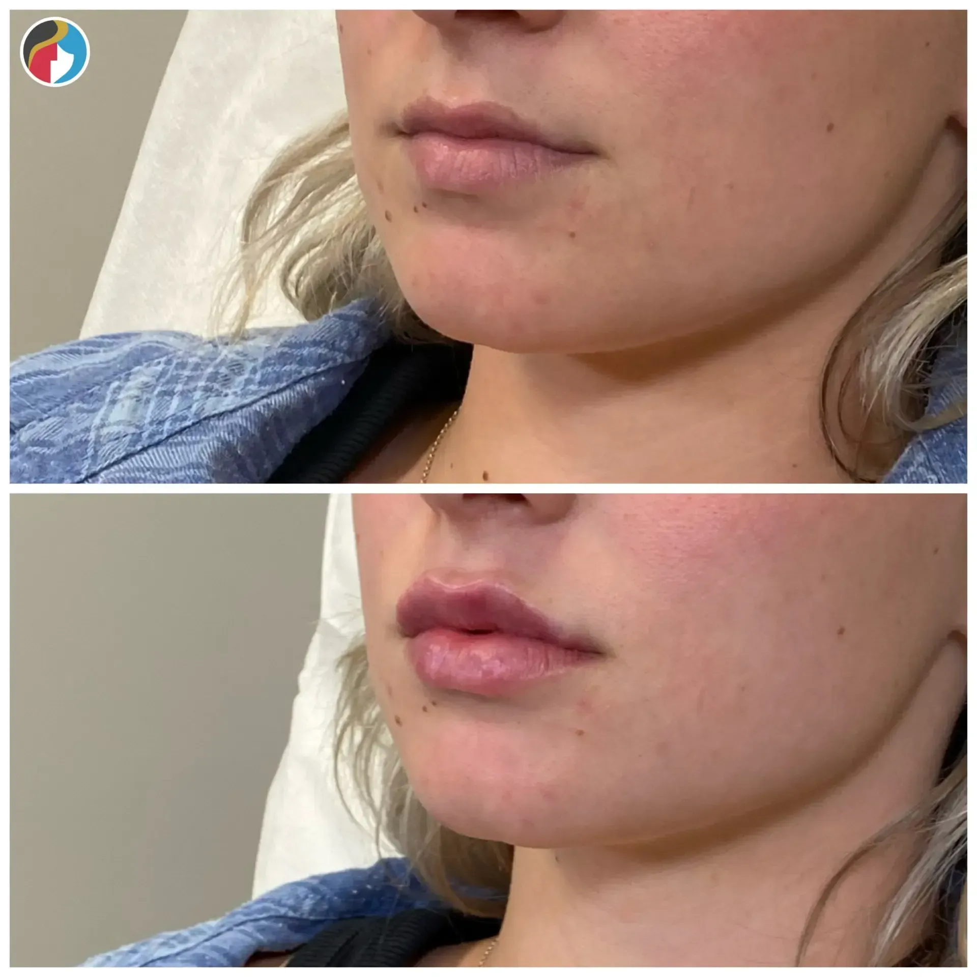 Lip Filler Results Lip Filler in Syracuse, New Hartford, and Albany, NY