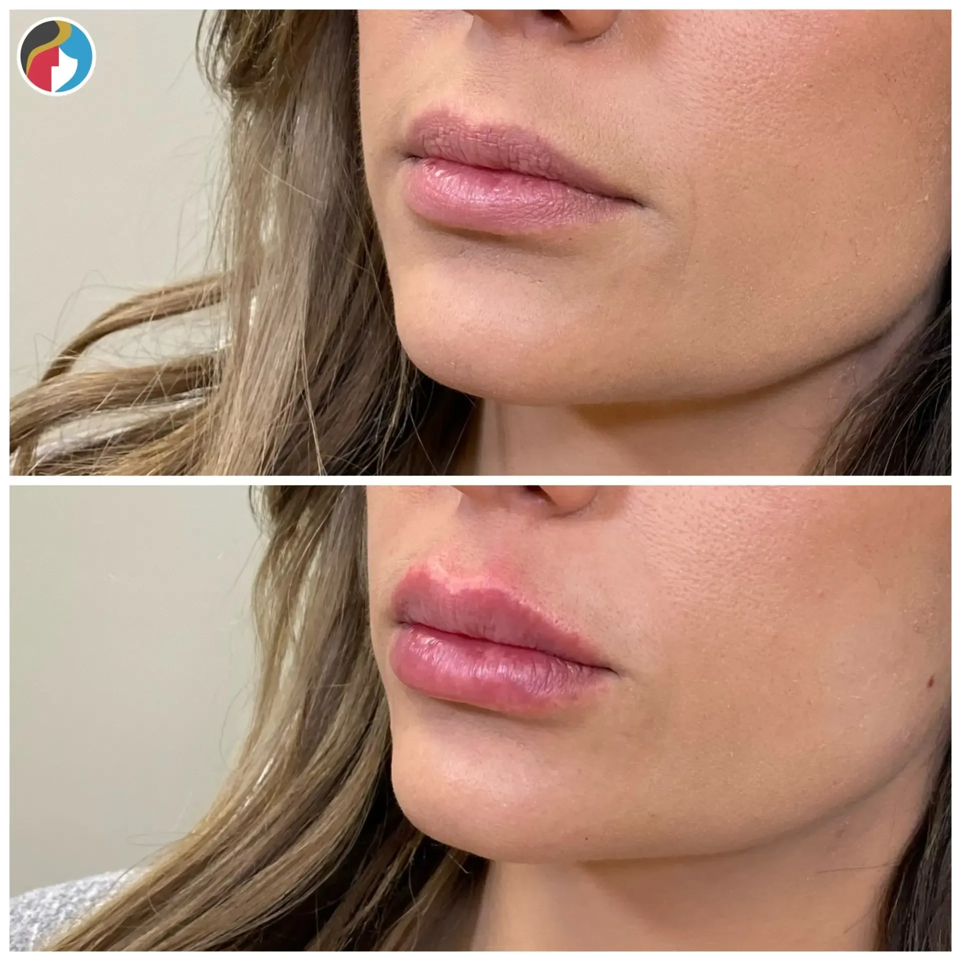 Lip Filler Results Lip Filler in Syracuse, New Hartford, and Albany, NY