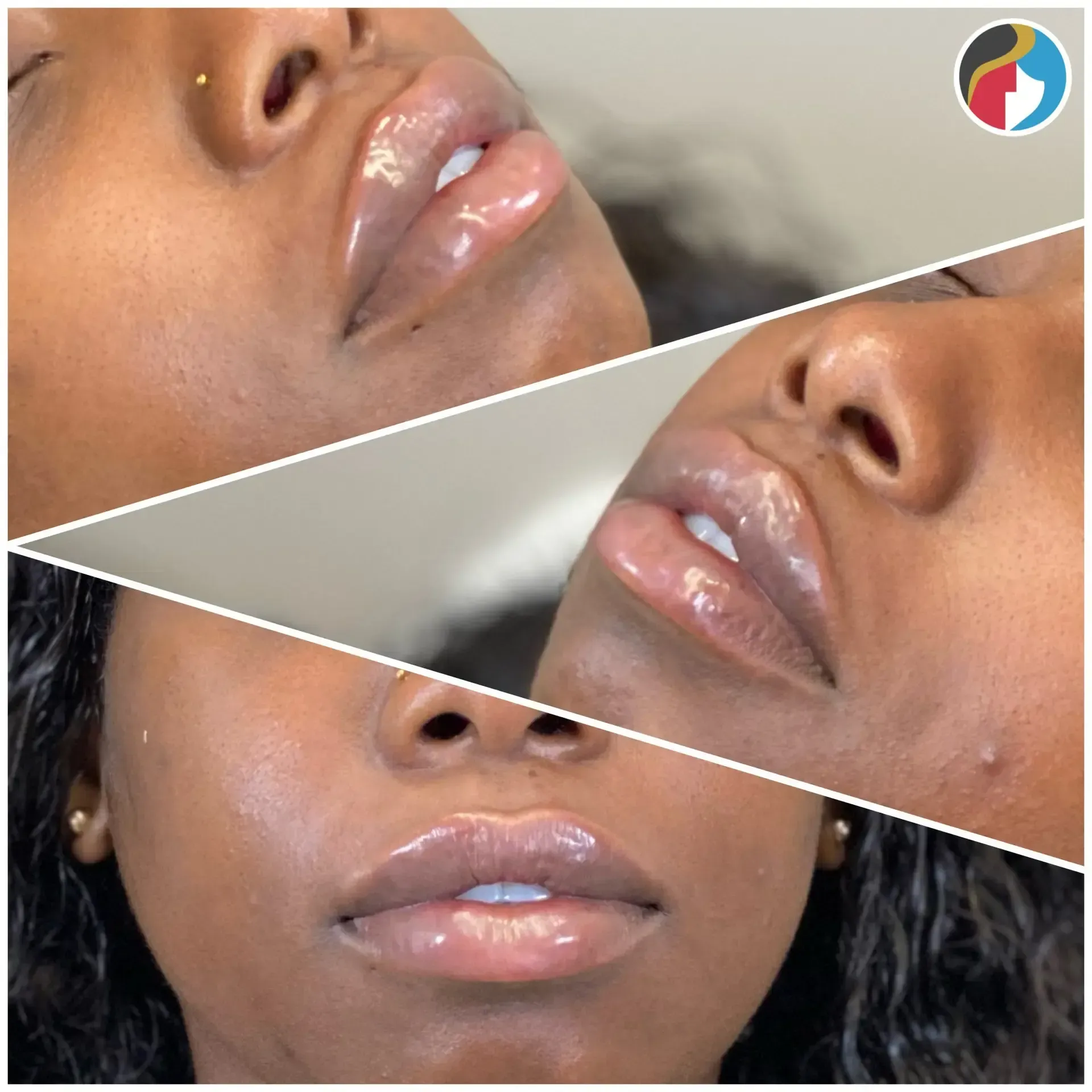 Lip Filler Results Lip Filler in Syracuse, New Hartford, and Albany, NY