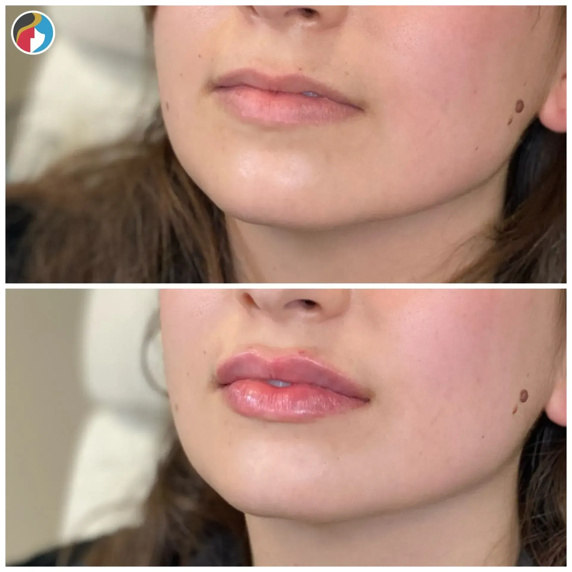 Lip Filler Results Lip Filler in Syracuse, New Hartford, and Albany, NY