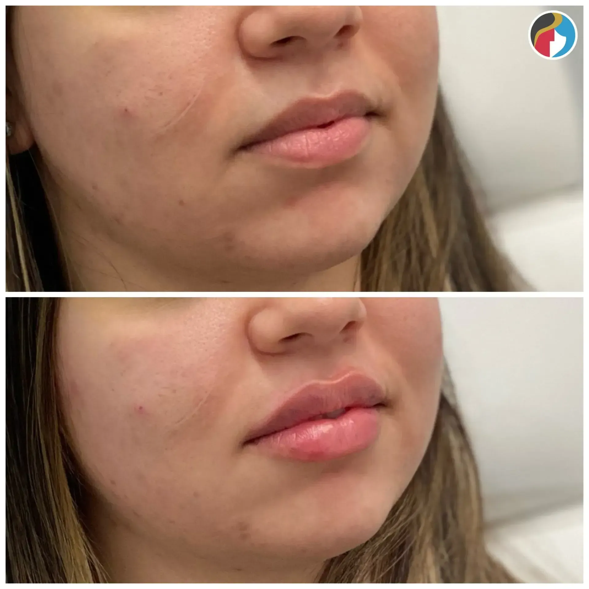 Lip Filler Results Lip Filler in Syracuse, New Hartford, and Albany, NY
