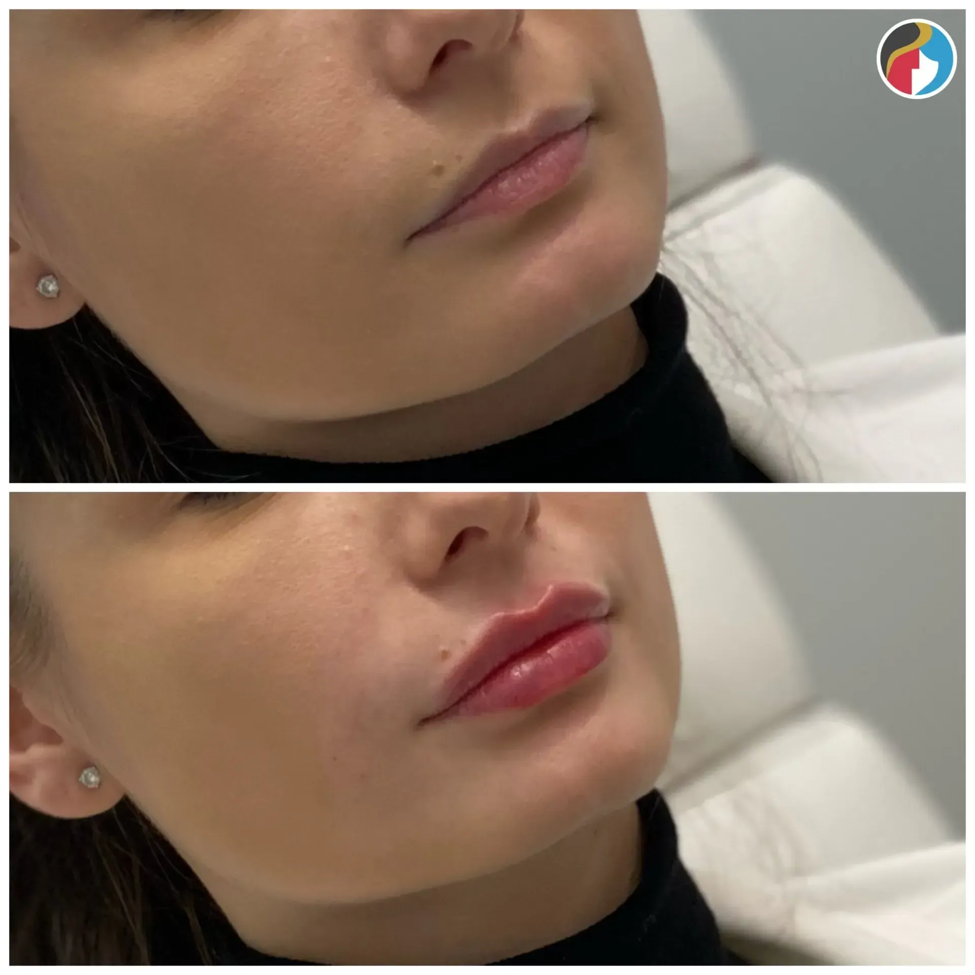 Lip Filler Results Lip Filler in Syracuse, New Hartford, and Albany, NY