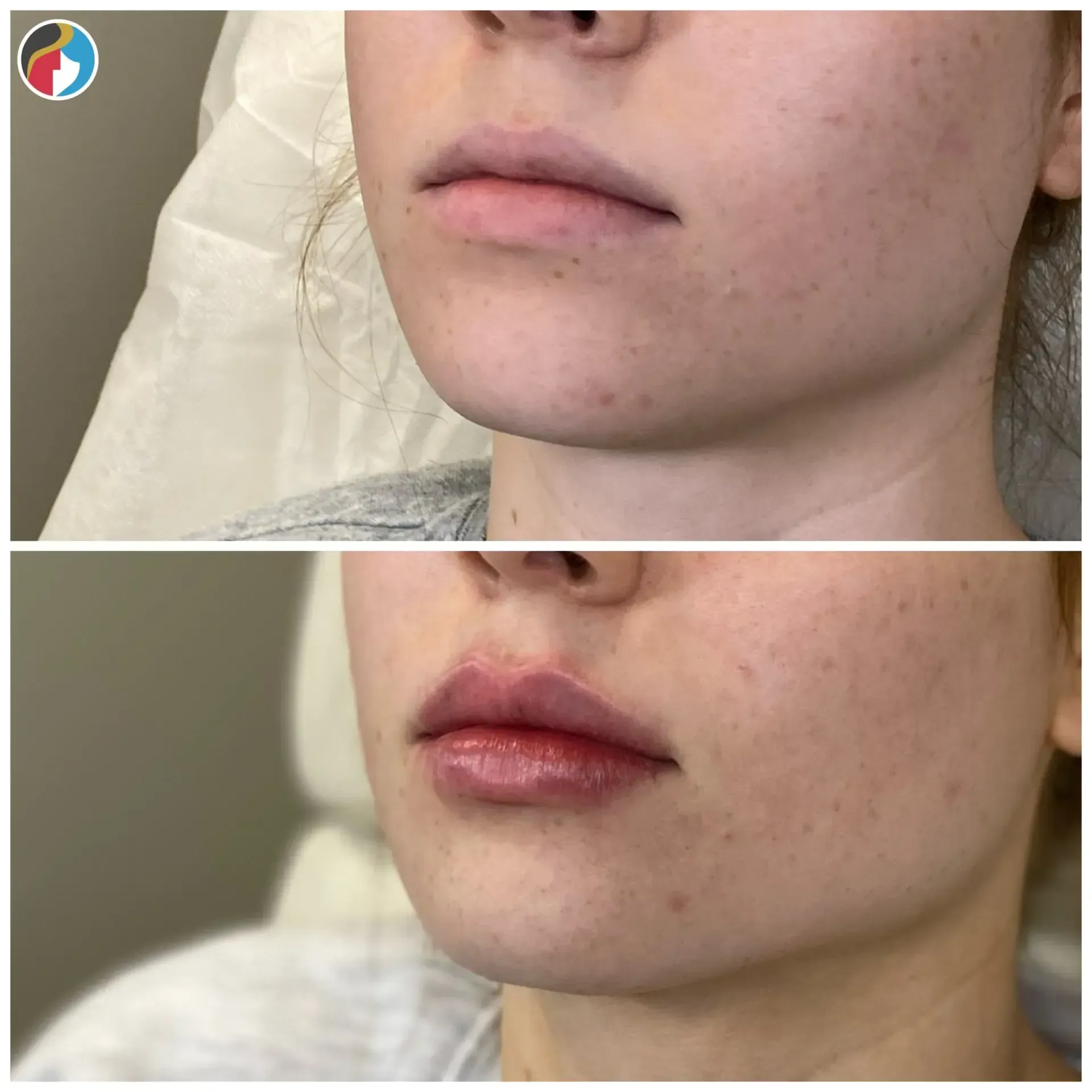 Lip Filler Results Lip Filler in Syracuse, New Hartford, and Albany, NY
