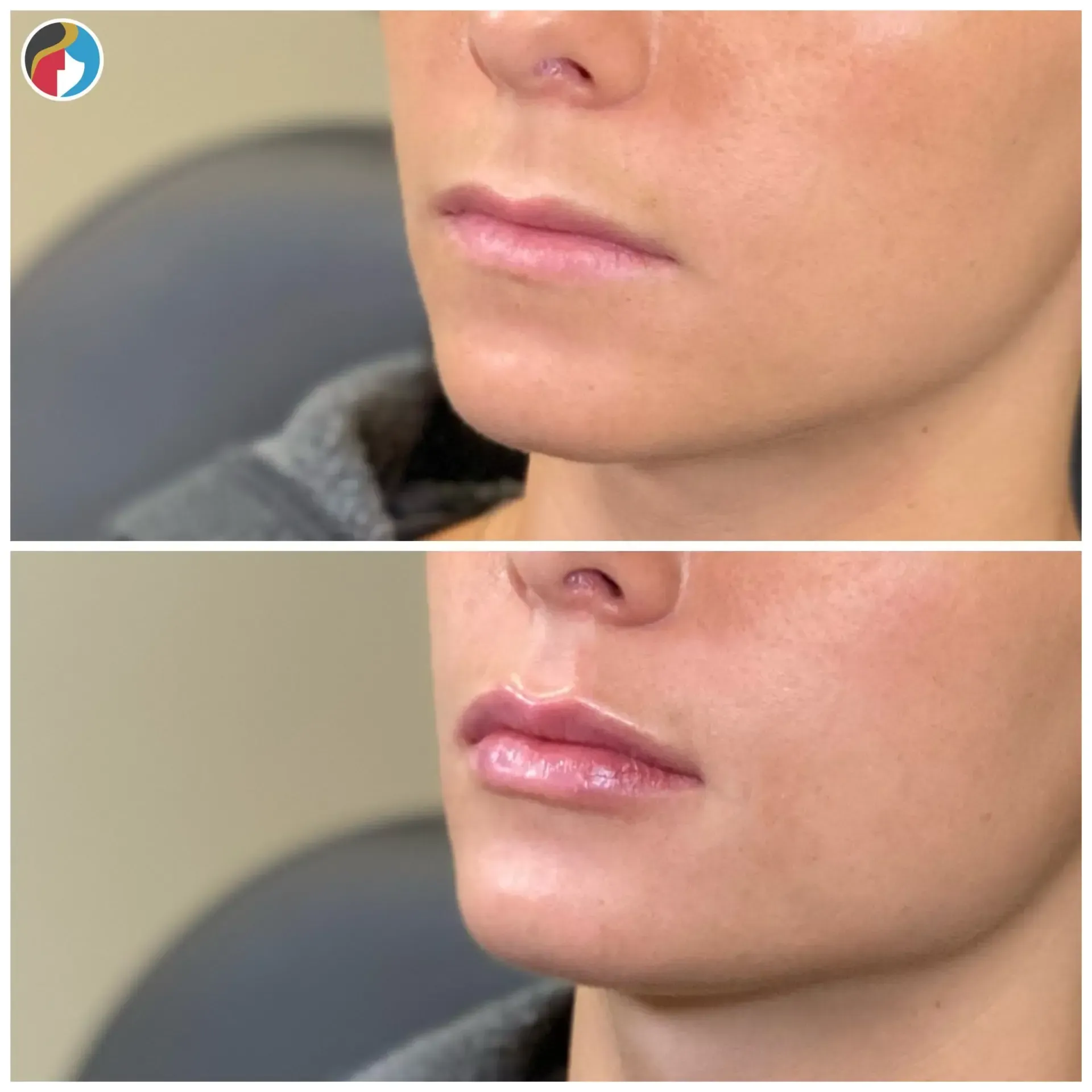 Lip Filler Results Lip Filler in Syracuse, New Hartford, and Albany, NY