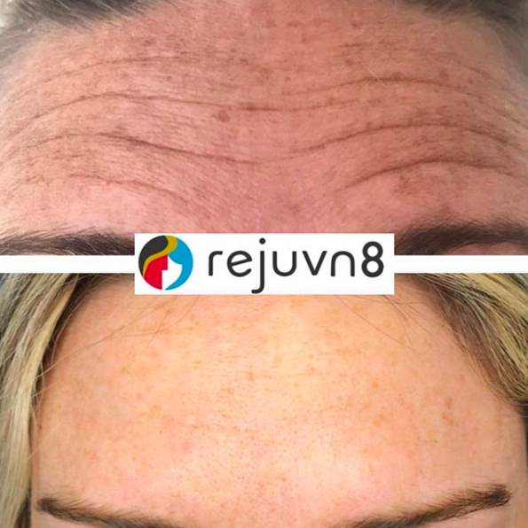 Neuromodulator treatment in Syracuse