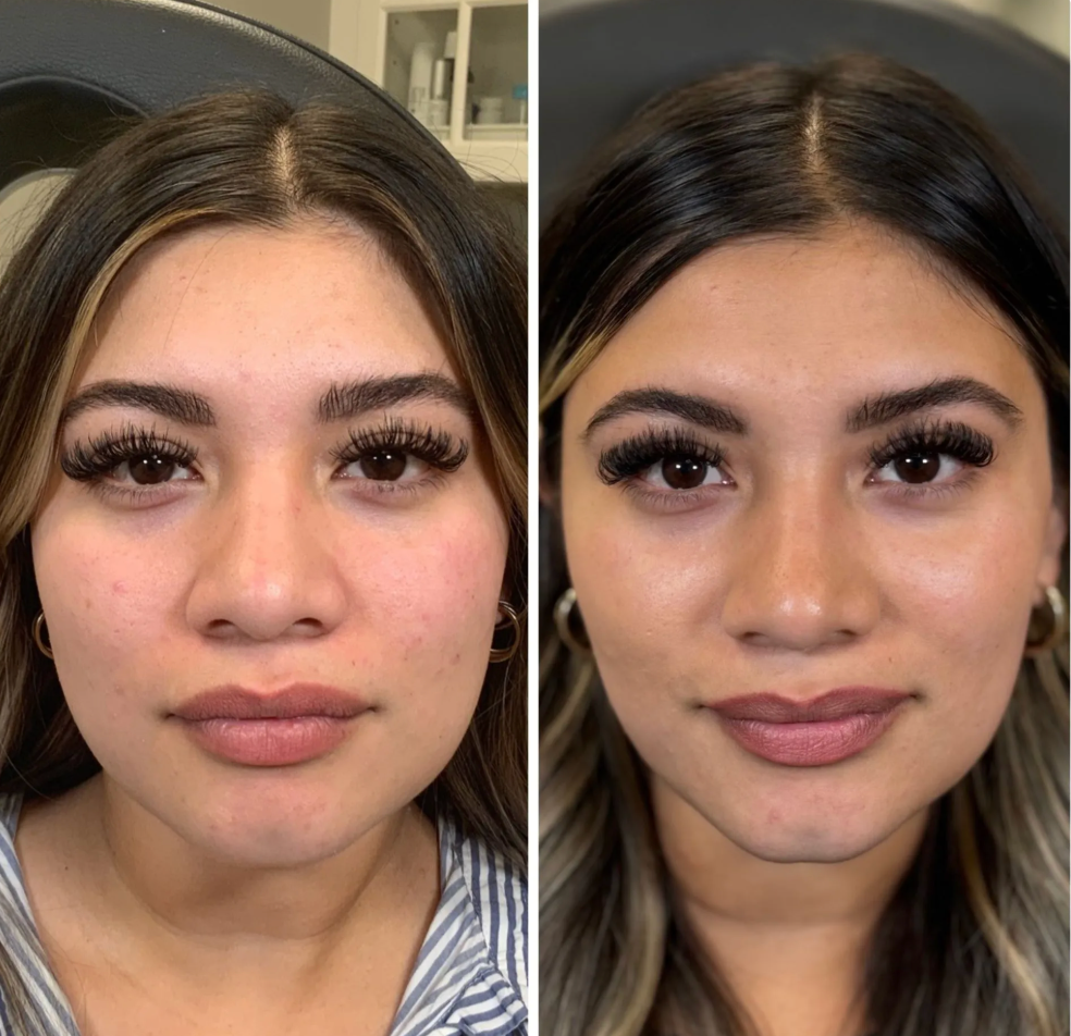 Patient about to receive Botox.