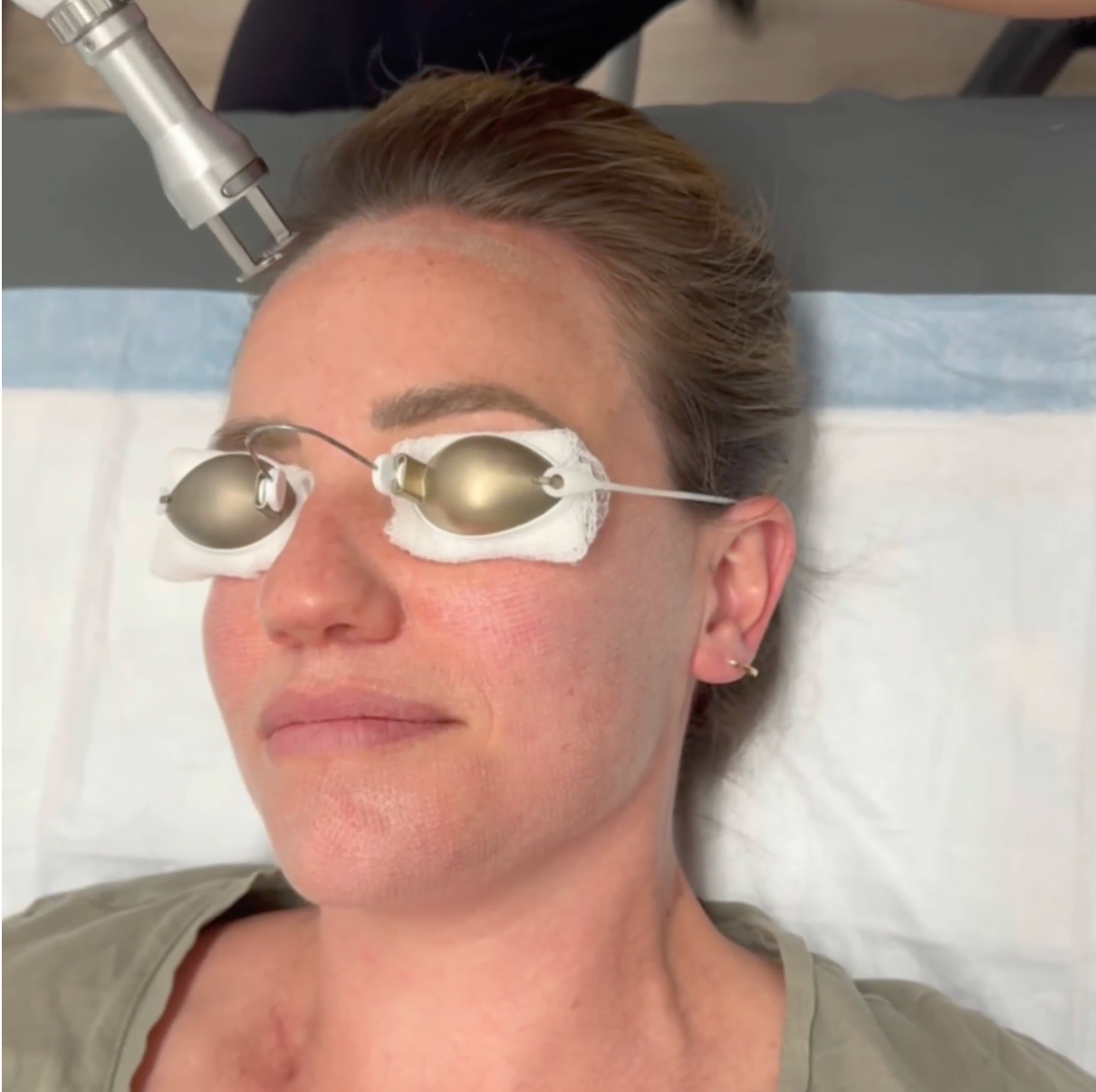 Dermaplanning treatment