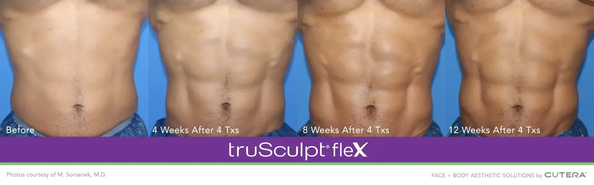 truSculpt flex Results truSculpt flex body sculpting in Syracuse