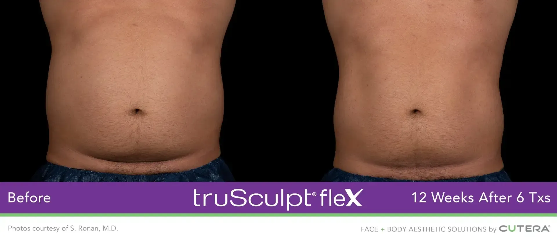 truSculpt flex Results body sculpting in Syracuse and in New Hartford