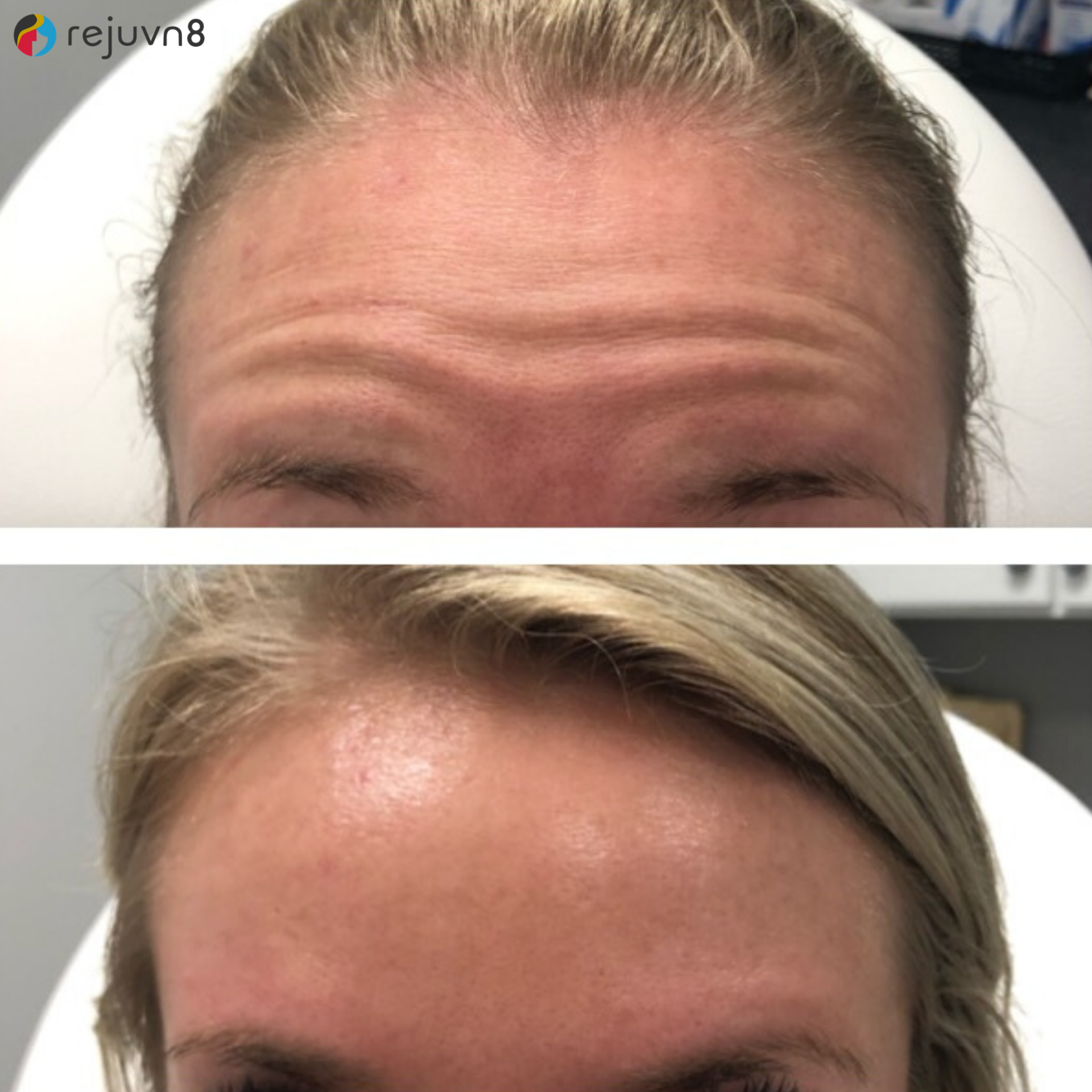 Botox in Syracuse for anti-aging 