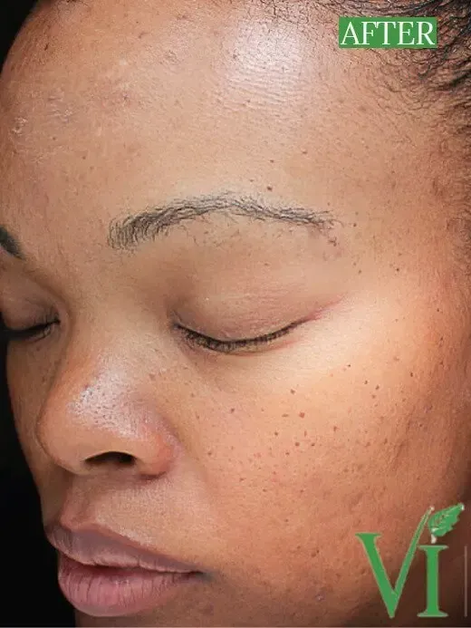 Chemical Peel Before and After