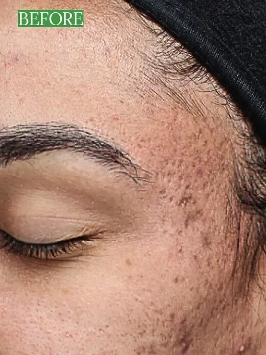 Chemical Peel Before and After