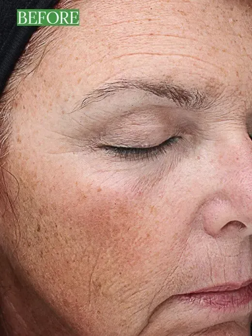 Chemical Peel Before and After