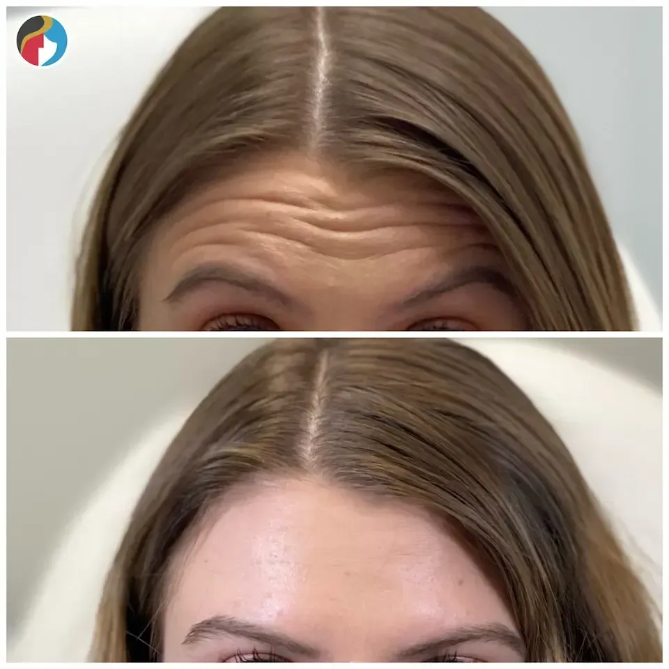 Botox treatment at Rejuvn8