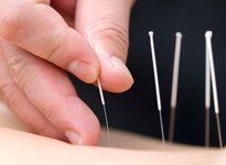 Acupuncture needles