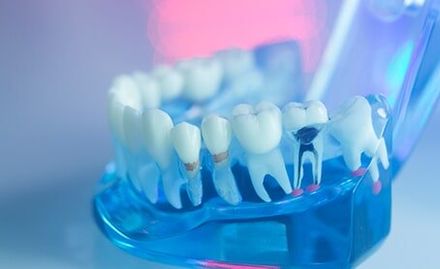 Dental Teeth, Mouth, Gums Dentists Teaching Model — Dental Office in Deerfield Beach, FL