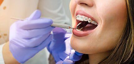 Woman Having Dental Check Up — Orthodontics in Deerfield Beach, FL