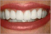 After Teeth Whitening — Teeth Whitening in Deerfield Beach, FL