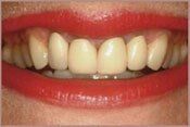 Before Teeth Whitening — Teeth Whitening in Deerfield Beach, FL