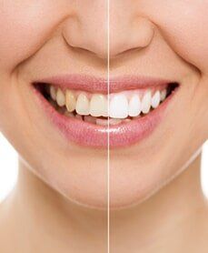 Teeth Whitening — Teeth Cleanings in Deerfield Beach, Fl