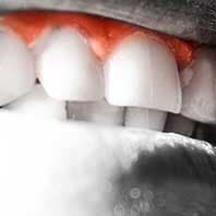Teeth Gums — Dental Practice in Deerfield Beach, Fl