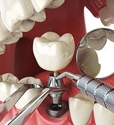 Dental Implant Procedure — Teeth Cleanings in Deerfield Beach, Fl