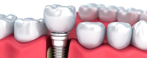 Tooth Implant — Dental Implants in Deerfield Beach, FL