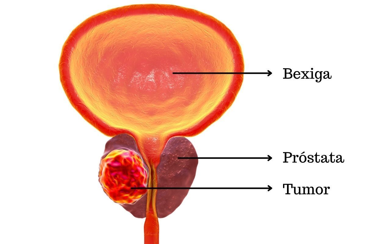 biopsia-prostata-dr-antonio-rocha-junior-urologista-teresina