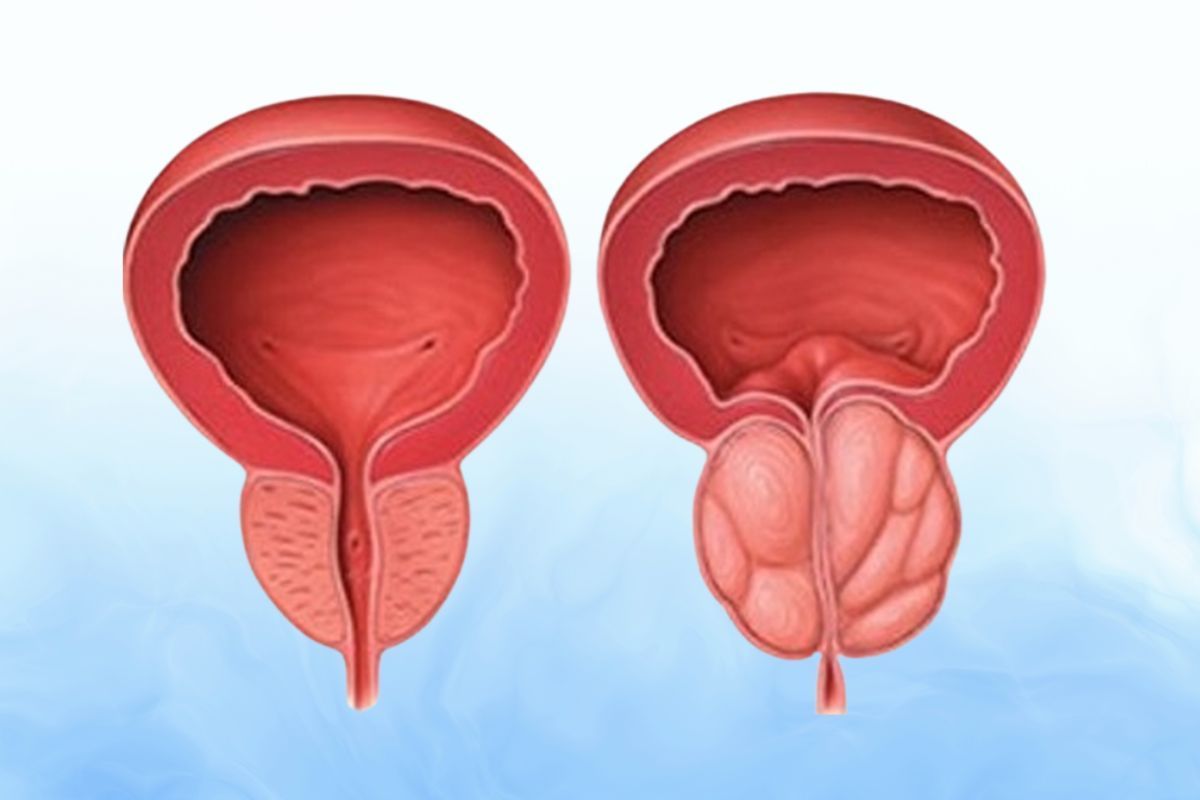 holep-prostata-dr-antonio-rocha-junior-urologista-teresina-piaui