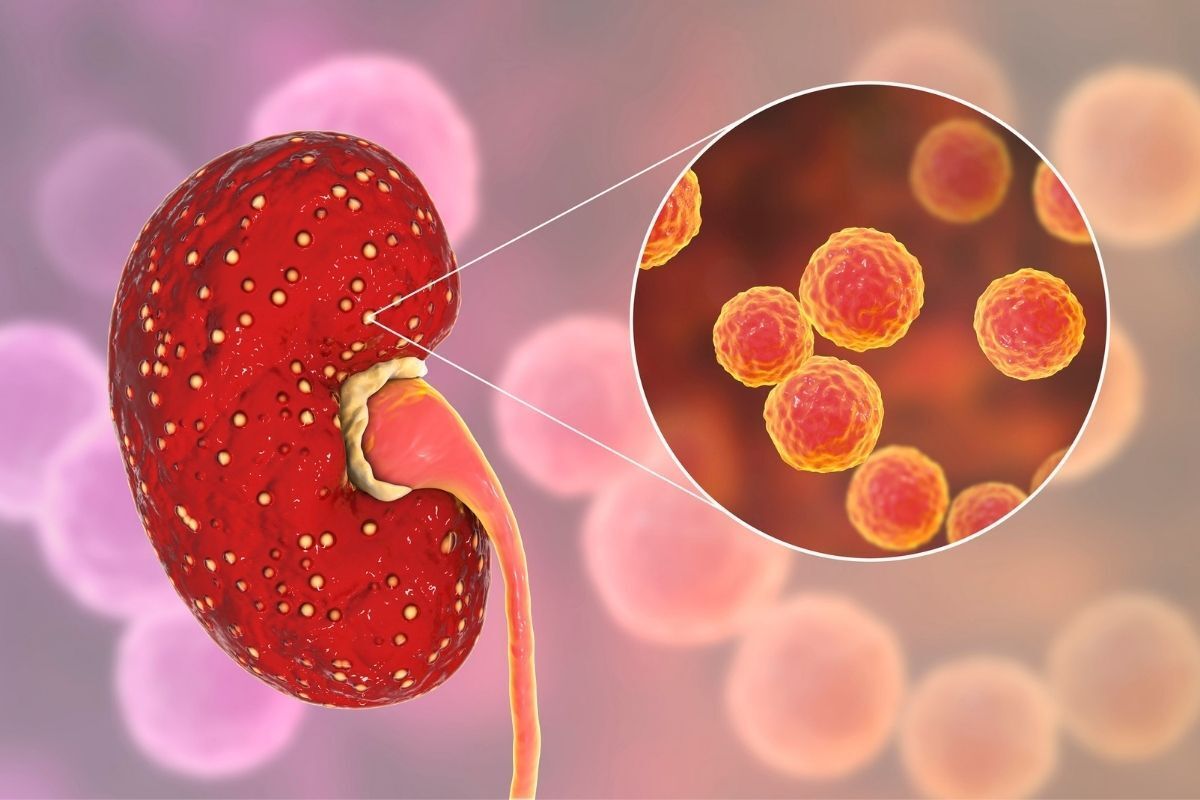 infeccao-trato-urinario-itu-dr-antonio-rocha-junior-urologista-teresina-piaui