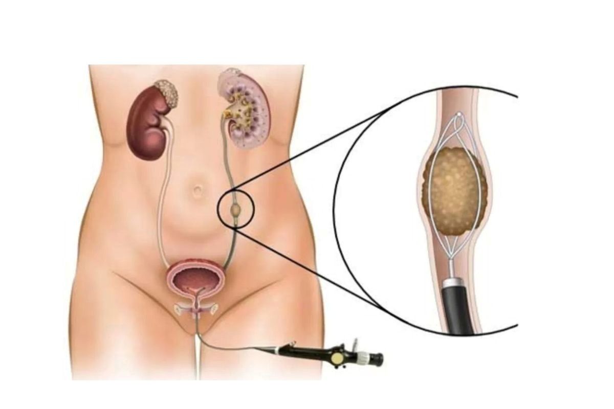 ureteroscopia-quando-fazer-dr-antonio-rocha-junior-urologista-teresina-piaui